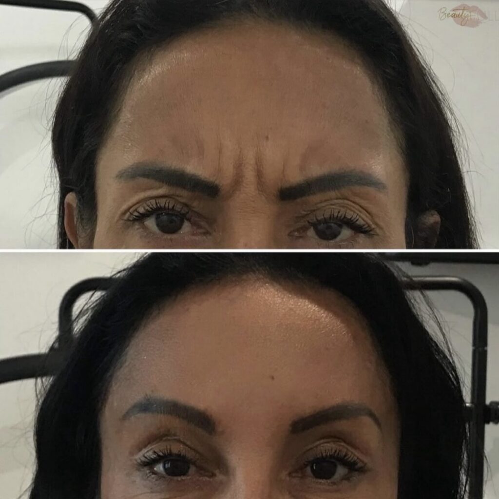 Threading Frown Line Frown Line Wrinkle Treatment - BeautyFULL Cosmetic Medical Clinic